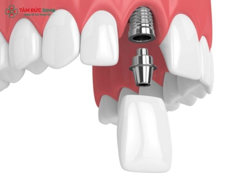 Front Tooth Implant: Anterior Single Tooth Implant, Crown, Cost, Care