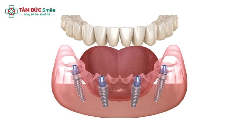 full-arch-dental-implants-1