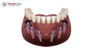 full-arch-dental-implants-2