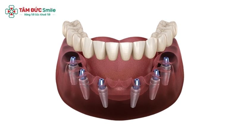 full-arch-dental-implants-2
