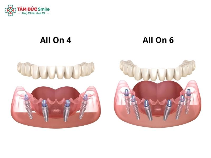 full-mouth-dental-implants-3
