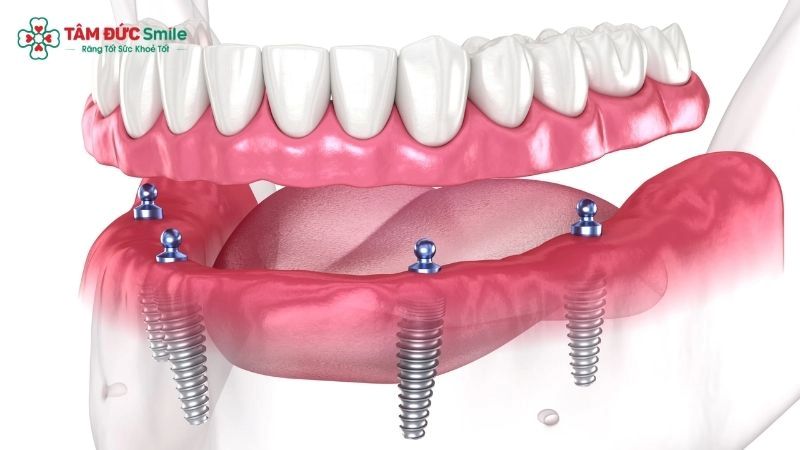 full-mouth-dental-implants-4