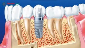 history-of-dental-implants-2