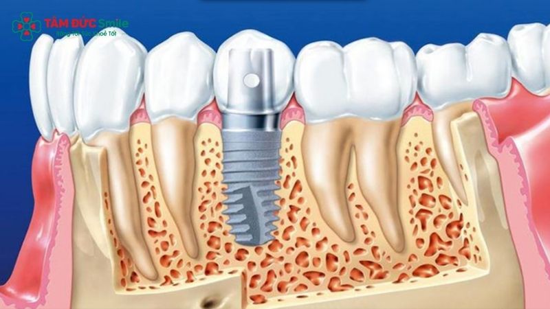 history-of-dental-implants-2
