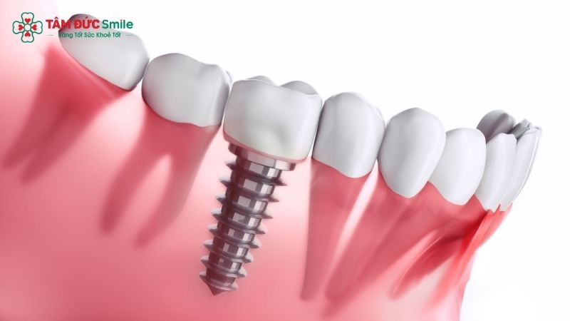 how-long-does-a-dental-implant-procedure-take-1