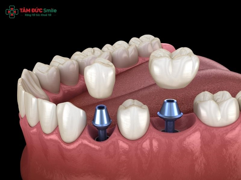 implant-abutment-2