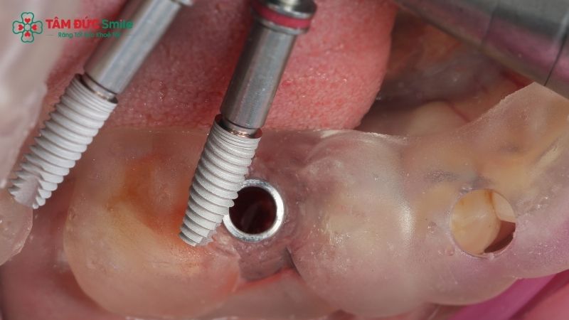 implant-surgical-guide-2