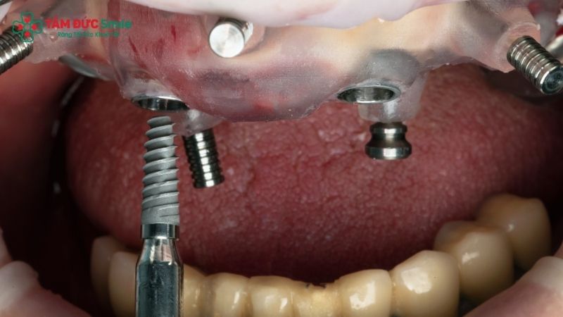 implant-surgical-guide-3
