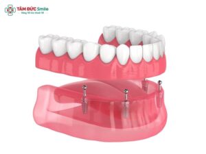 mini-dental-implants-1