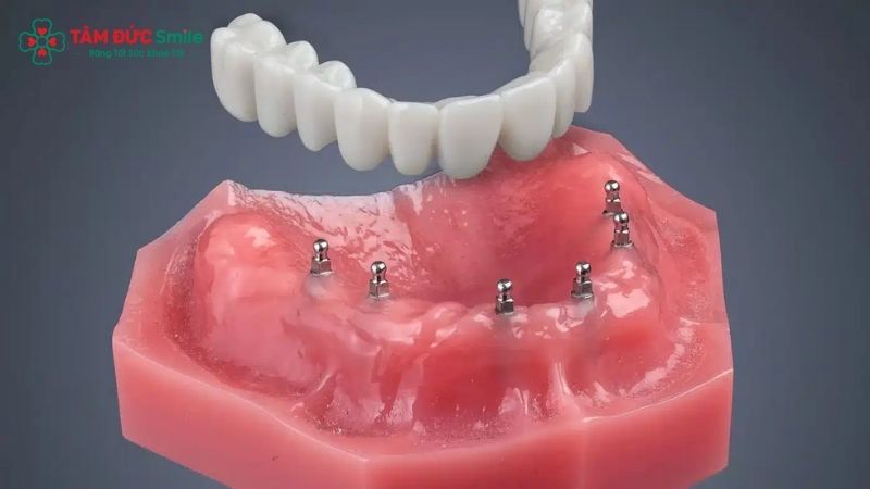 mini-dental-implants-2
