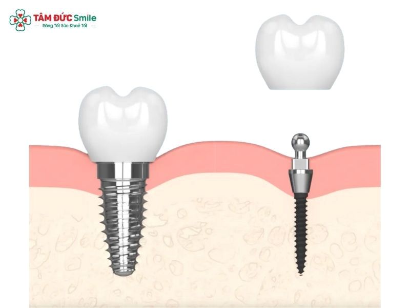 mini-dental-implants-4