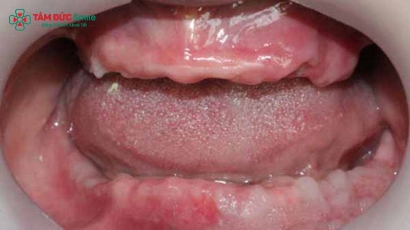 multiple-tooth-implants-2