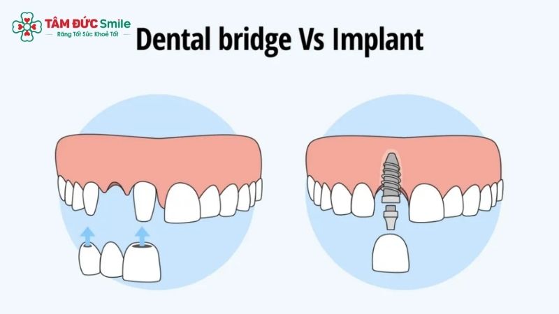 one-tooth-implant-3