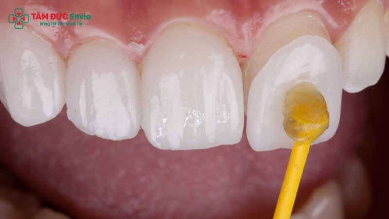 porcelain-veneers-1