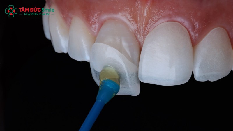porcelain-veneers-2