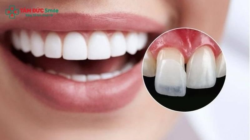 porcelain-veneers-3