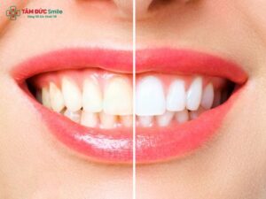 teeth-whitening-1