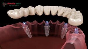 tooth-implant-3