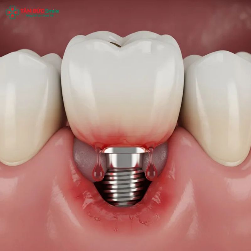 tooth-implant-side-effects-2