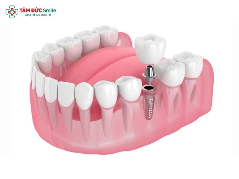 tooth-implant-side-effects-3