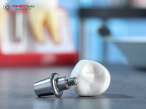 what-is-an-abutment-2