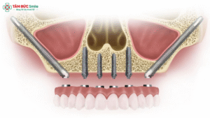 zygomatic-dental-implants-1