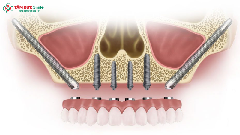 zygomatic-dental-implants-1