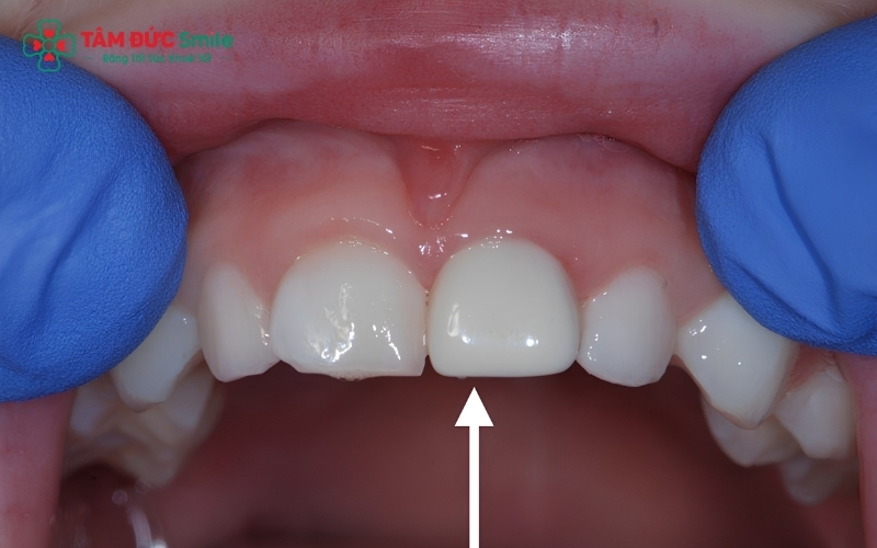 Cấu trúc răng trẻ 13 tuổi có buồng tủy lớn và chân răng chưa hoàn thiện, việc mài răng để bọc sứ rất dễ gây hỏng tủy và đau nhức.
