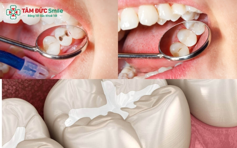 Trám răng thẩm mỹ là giải pháp bảo tồn tối ưu giúp khắc phục khuyết điểm răng cho trẻ mà không cần xâm lấn mô răng thật.