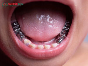 13 tuổi bọc răng sứ được không? 