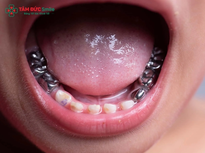 13 tuổi bọc răng sứ được không?