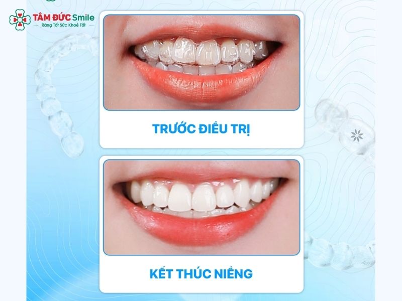 24-tuoi-nieng-rang-duoc-khong-1