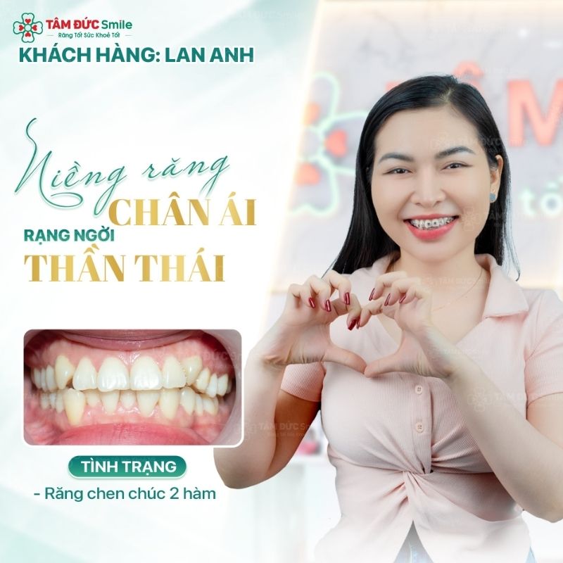 25 tuổi vẫn có thể niềng răng