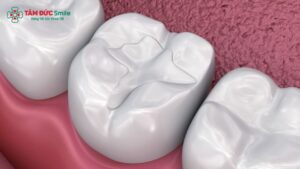 Hàn răng là một kỹ thuật sử dụng vật liệu nhân tạo để phục hồi phần mô răng bị hư hỏng