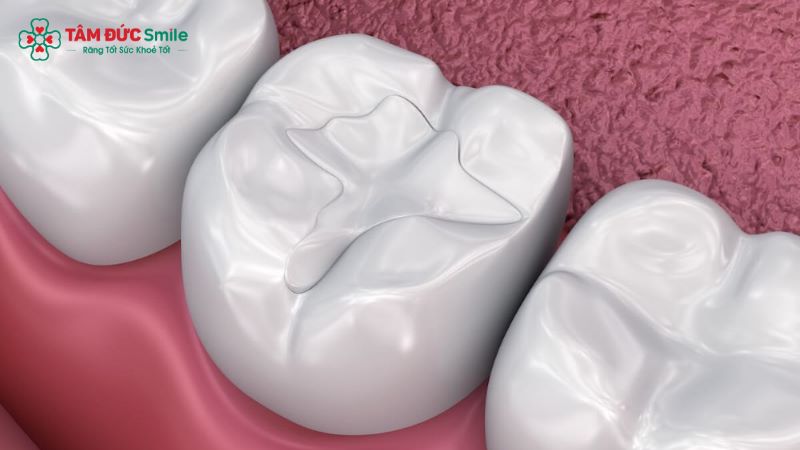 Hàn răng là một kỹ thuật sử dụng vật liệu nhân tạo để phục hồi phần mô răng bị hư hỏng