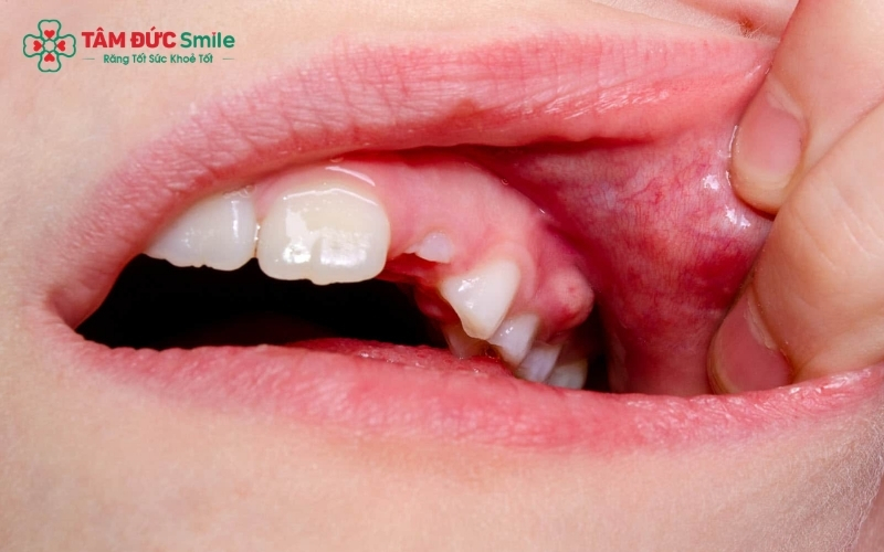 Áp xe răng là ổ nhiễm trùng chứa mủ tại chân răng hoặc mô nướu, cần được phát hiện và điều trị kịp thời để tránh biến chứng.