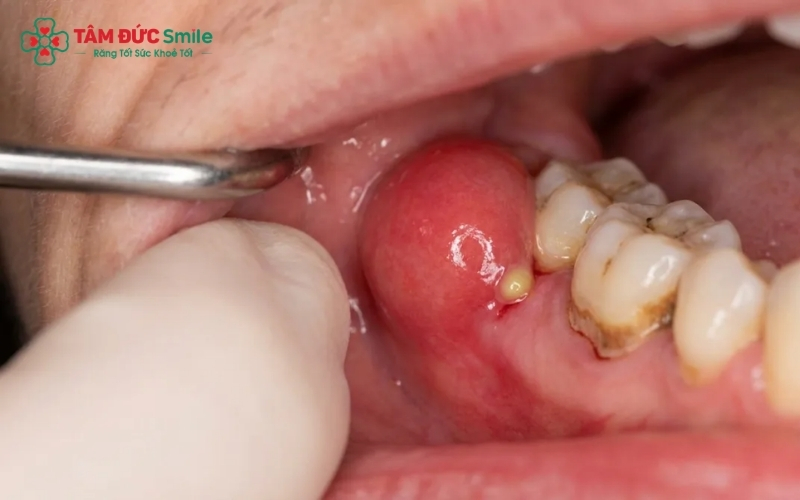 Áp xe nướu bề mặt là tình trạng nhiễm trùng khu trú tạo túi mủ nhỏ ngay trên mô nướu