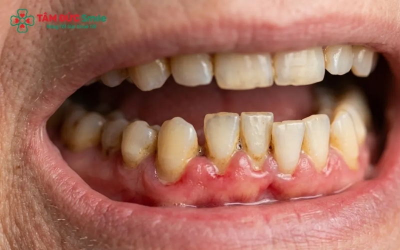 Ổ áp xe để lâu có thể gây tiêu xương hàm và ảnh hưởng đến sức khỏe toàn thân