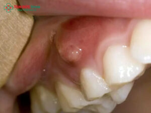 Áp xe răng là gì? Phương pháp điều trị áp xe răng