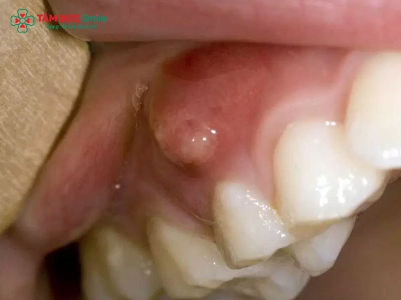 Áp xe răng là gì? Phương pháp điều trị áp xe răng