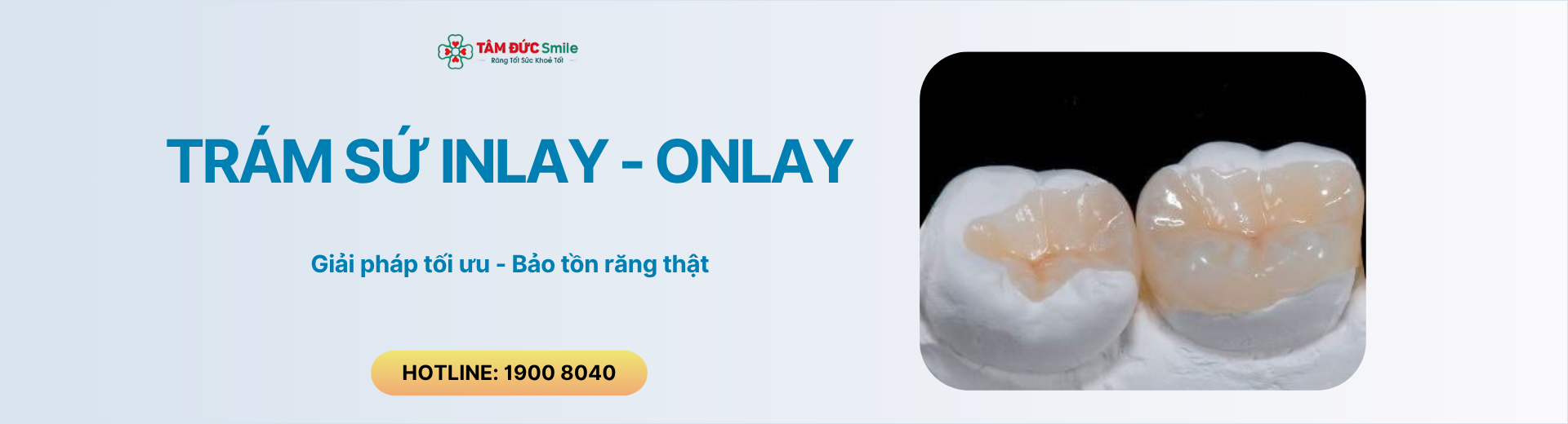 Trám Sứ Inlay – Onlay: Giải Pháp Phục Hình Thẩm Mỹ Giúp Bảo Tồn Mô Răng
