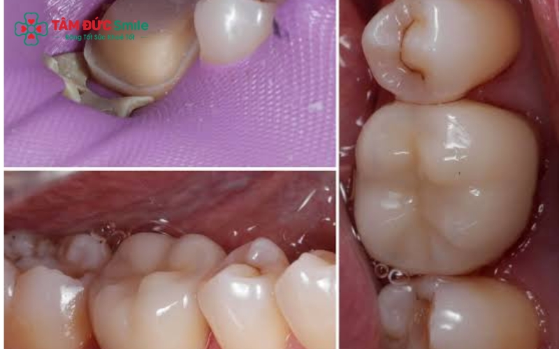 Bọc răng sứ là phương pháp phục hình hiệu quả, giúp tái tạo lại hình dáng và chức năng cho những chiếc răng bị sâu hỏng, mất nhiều mô răng.