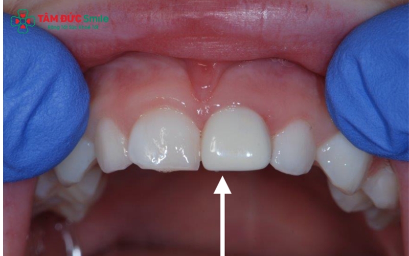 Răng sau khi điều trị tủy rất dễ nứt vỡ, việc bọc sứ kịp thời giúp kéo dài tuổi thọ cho răng thật và ngăn ngừa vi khuẩn xâm nhập trở lại.