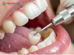 Bọc răng sâu có được không? Quy trình tại Nha khoa.