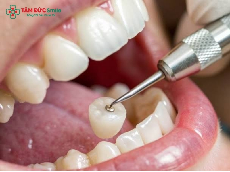 Bọc răng sâu có được không? Quy trình tại Nha khoa.