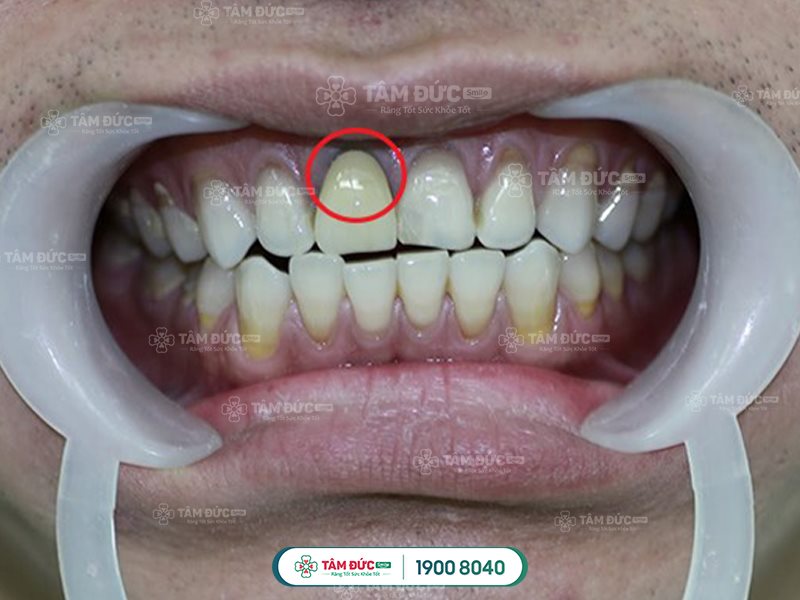 Răng sứ kim loại bị đen viền nướu sau một thời gian sử dụng