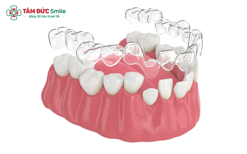 Niềng răng trong suốt mang lại tính thẩm mỹ cao, giúp bạn tự tin giao tiếp trong suốt quá trình chỉnh nha