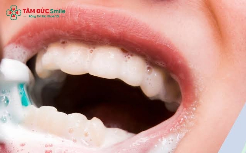 Tuyệt đối không lạm dụng và cần kết hợp vệ sinh răng miệng bằng kem đánh răng chứa Fluoride hàng ngày