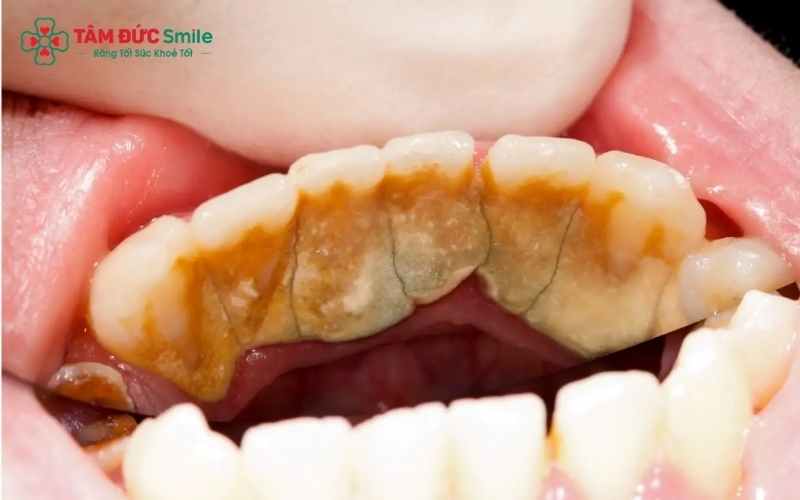 Cao răng là lớp mảng bám đã khoáng hóa, bám cứng trên bề mặt răng mà bàn chải thông thường không thể làm sạch được.