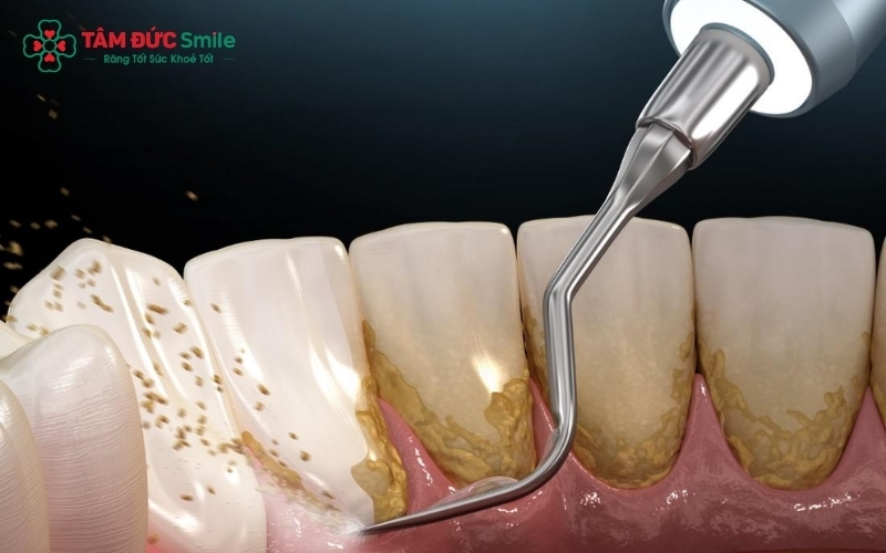 Đánh răng chỉ làm sạch mảng bám mềm; cao răng đã hình thành cần được loại bỏ bởi bác sĩ nha khoa với dụng cụ chuyên dụng.
